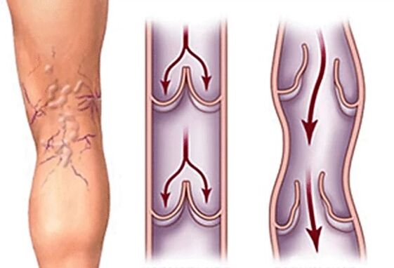 Normal and varicose vein