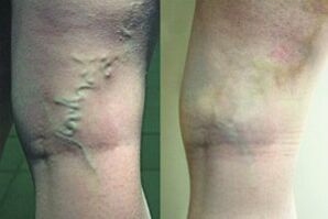 Varicose veins on the legs