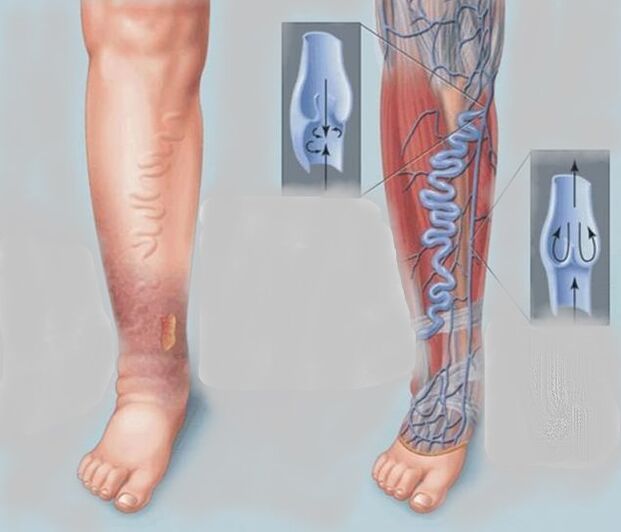 Varicose veins in the legs.
