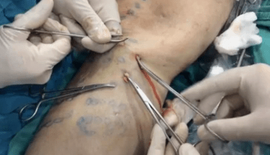 How is phlebetomy performed to remove varicose veins