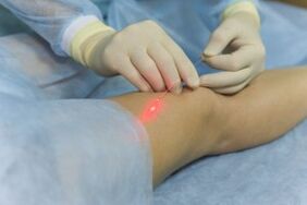 Surgical intervention for varicose veins in the legs.