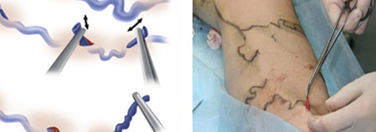 Surgical treatment of veins.