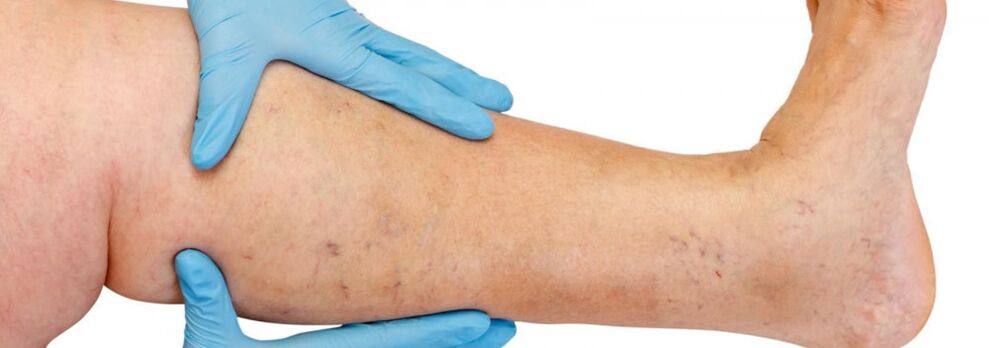 Varicose veins in the leg.