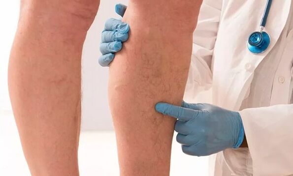 The doctor examines the legs for varicose veins.